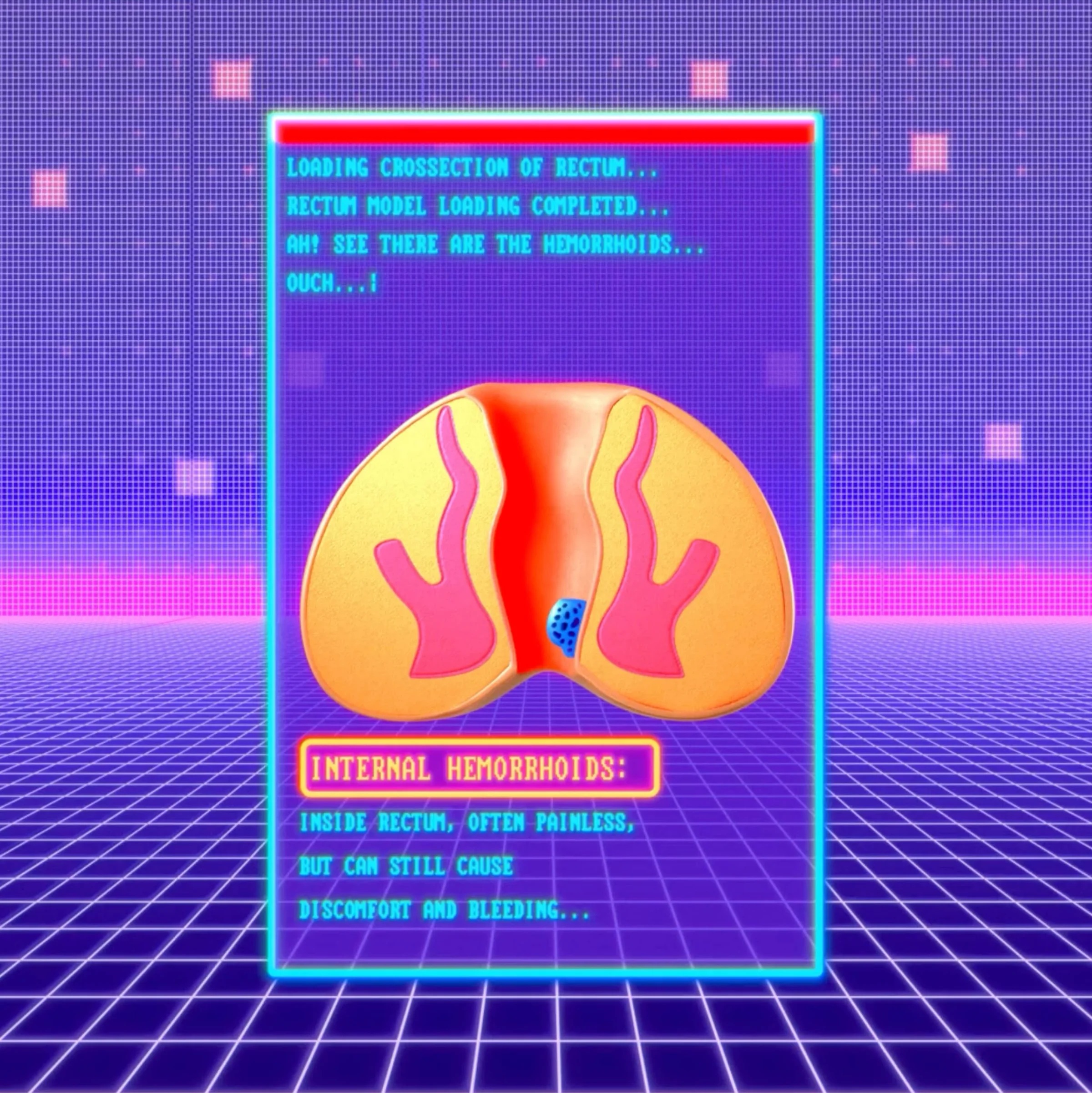 Retro computer graphic of a rectum cross-section labeled internal hemorrhoids
